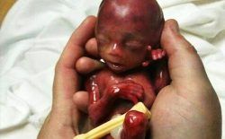 کوچکترین نوزاد جهان پس از ۵ ماه بستری از شفاخانه رخصت شد