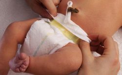 علایم عفونت بند ناف نوزادان