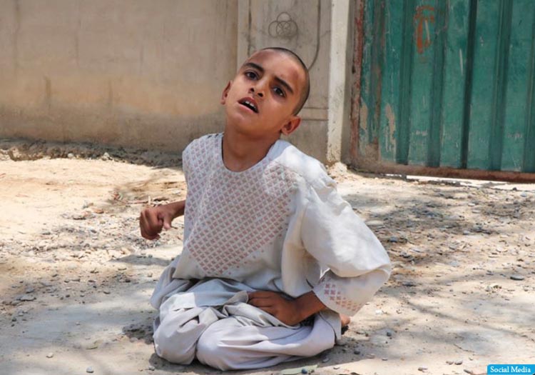 سه مورد جدید بیماری پولیو در کندهار، ارزگان و هلمند ثبت شد